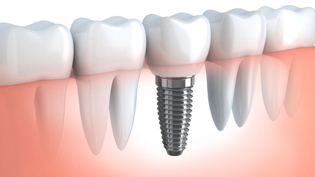 L'implant dentaire : une dent permanente pour remplacer l'édentation -  Cabinet dentaire Kara Mostefa