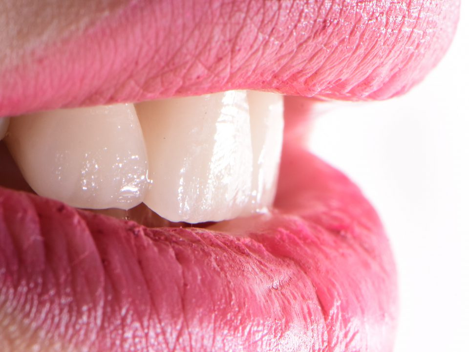 Facette Dentaire et Hollywood Smile