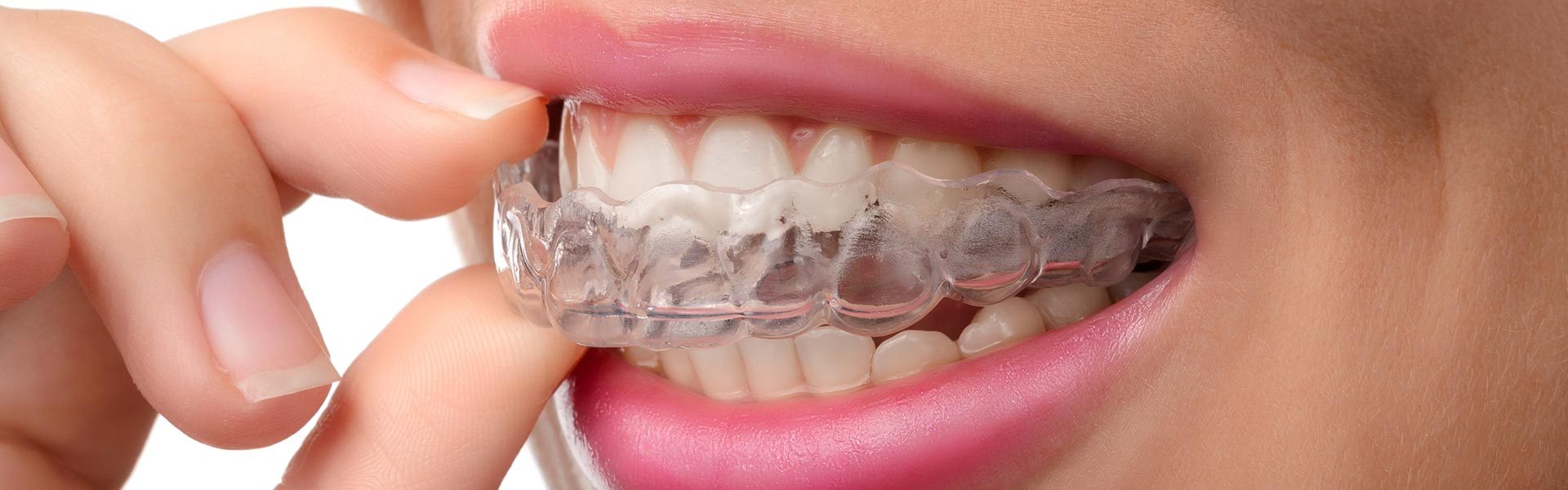 Gouttière dentaire transparente en Algérie - Naoufel Dental Center