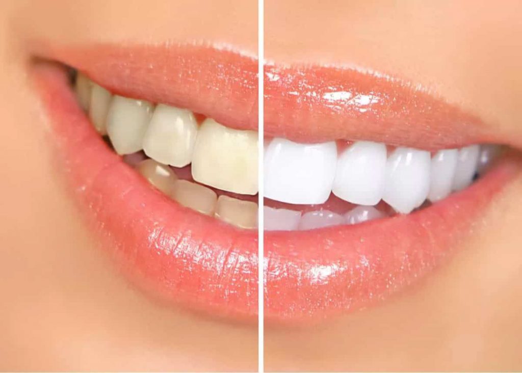 تبييض الأسنان تبييض الأسنان علاج الأسنان الصفراء عيادة الأسنان قارة مصطفى البليدة الجزائر
