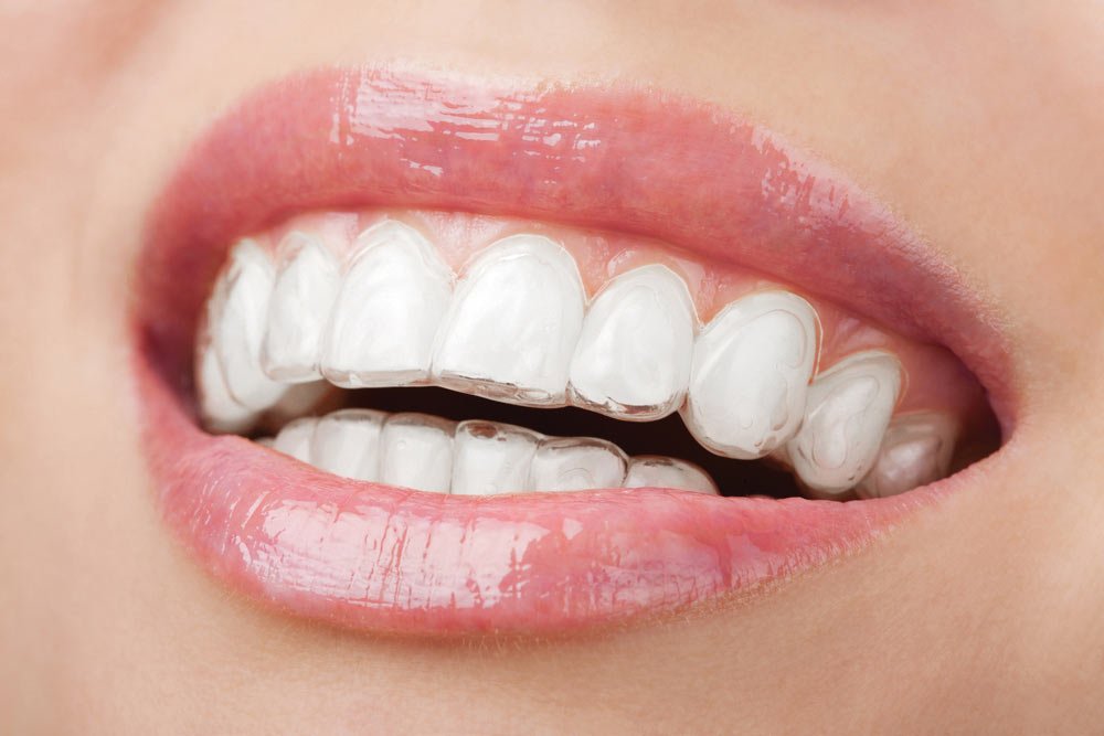 Sanabrux - Protection dentaire contre les grincements de dents
