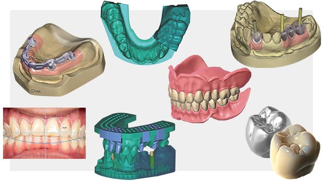 Modélisation prothèse dentaire 3D - design4me