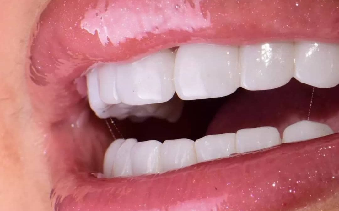 hollywood smile algérie