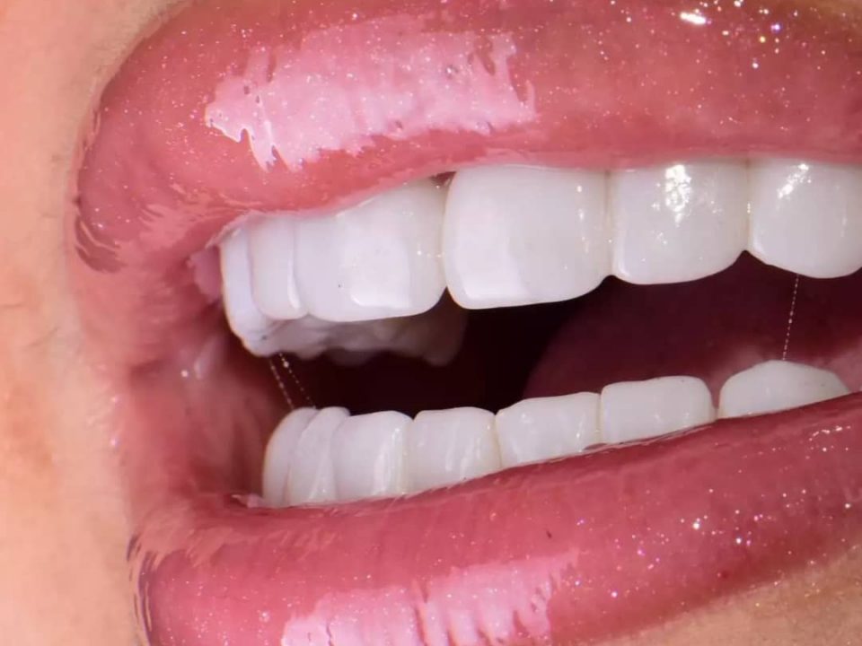 Prix d’un Hollywood Smile en Algérie : ce qui justifie les écarts de tarifs