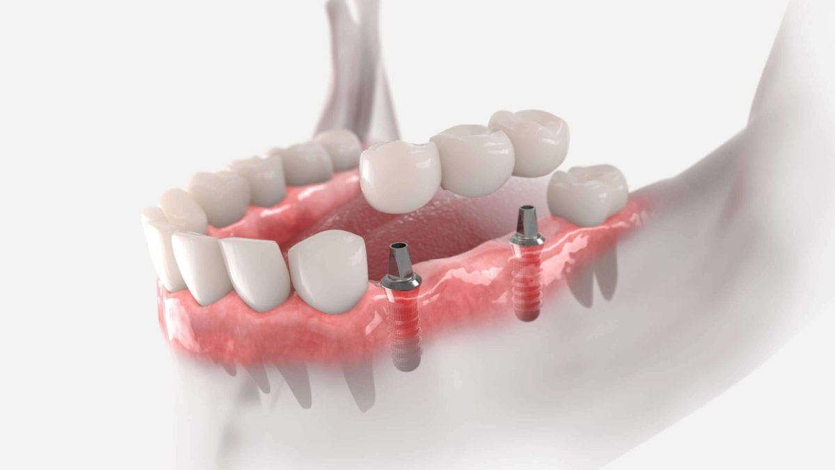 bridge complet sur implant dentaire en Algérie à Blida