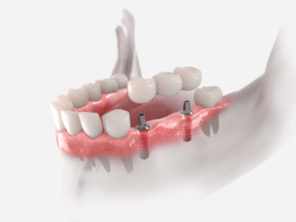 Le Bridge sur Implant Dentaire en Algérie à Blida : Une Solution Robuste pour un Sourire Complet et Fonctionnel