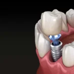 implant dentaire à Blida en Algérie, implant dentaire en zircone à Blida en Algérie