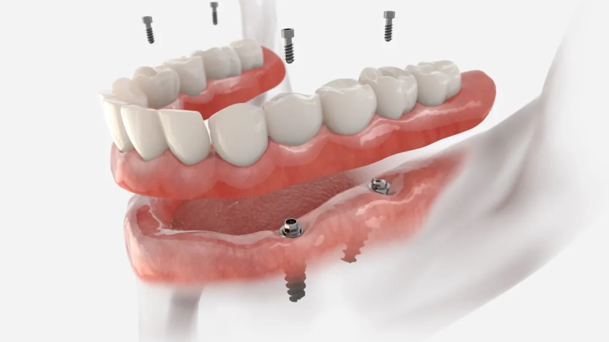 prothèse dentaire fixée sur implants dentaires en Algérie à Blida