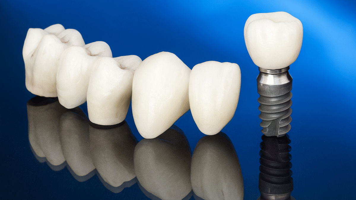 bridge dentaire ou implant dentaire en Algérie, choix, différences, guide complet