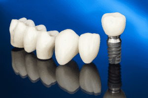 bridge dentaire ou implant dentaire en Algérie, choix, différences, guide complet