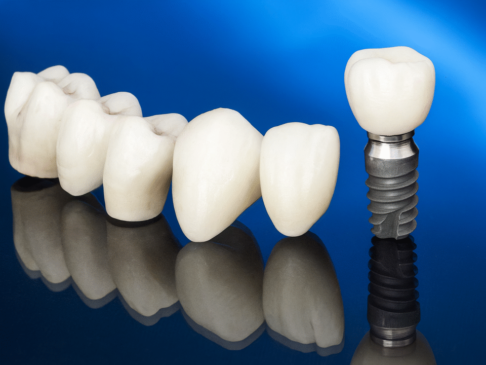 Bridges dentaires ou implants : quand et pourquoi préférer l’un à l’autre ?