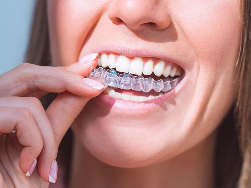 aligneur invisible, appareil dentaire transparent, orthodontie invisible, odf transparent en Algérie