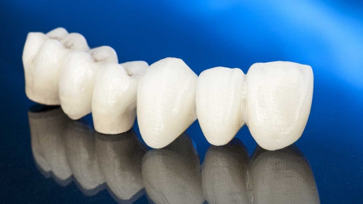 bridge dentaire en Algérie