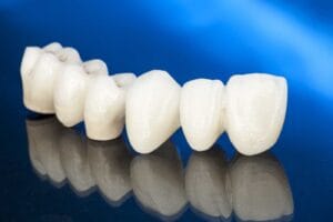 bridge dentaire en Algérie