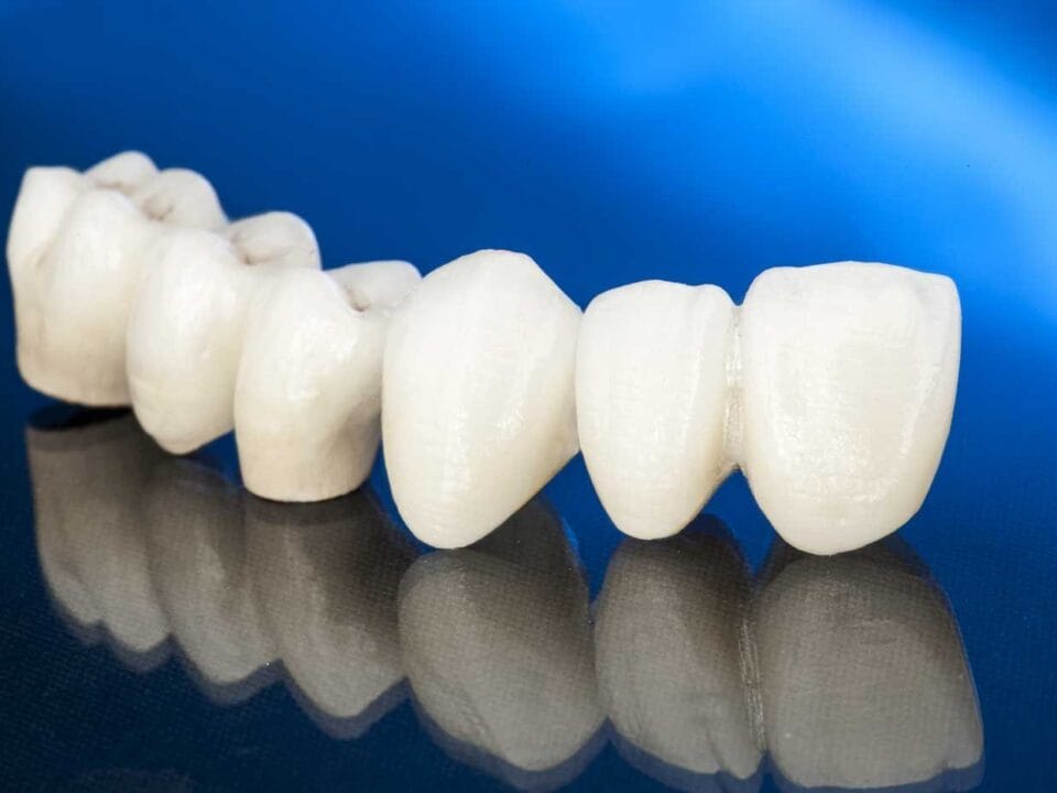 Bridge dentaire nouvelle génération : durabilité, esthétique et confort