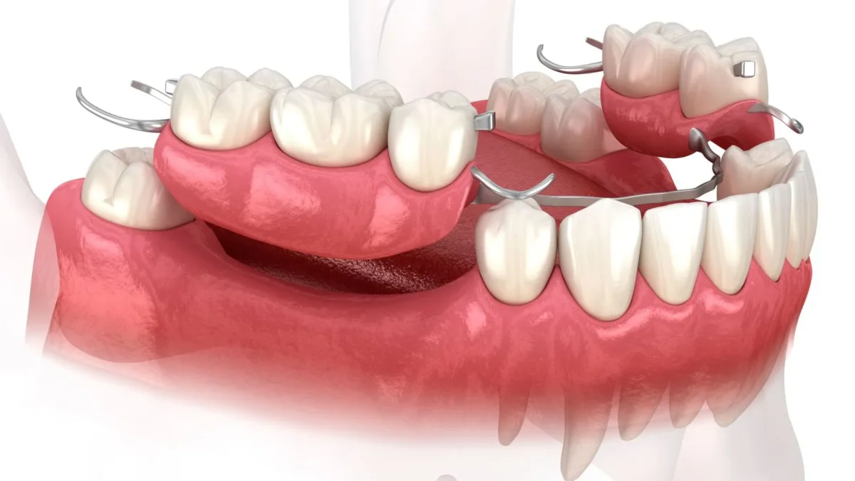 bridge dentaire amovible en Algérie