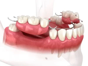 bridge dentaire amovible en Algérie