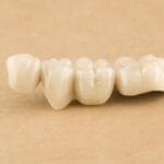 bridge dentaire, durée de vie et alimentation en Algérie