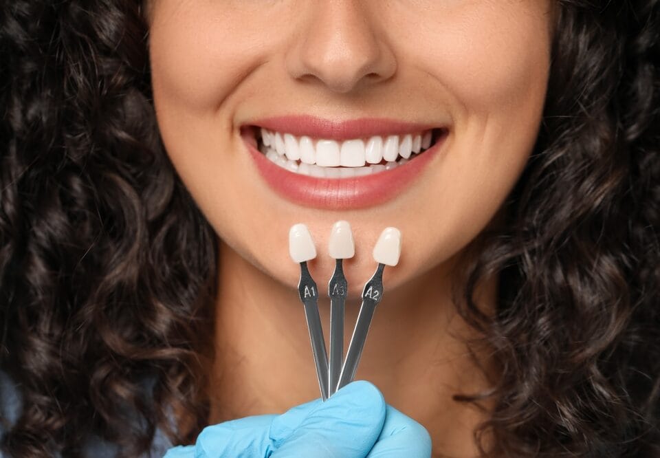 Hollywood Smile : étapes clés du premier rendez-vous à la pose finale