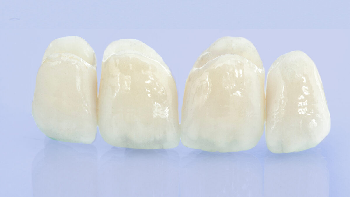 Couronnes dentaires pour adolescents et enfants en Algérie