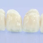 Couronnes dentaires pour adolescents et enfants en Algérie