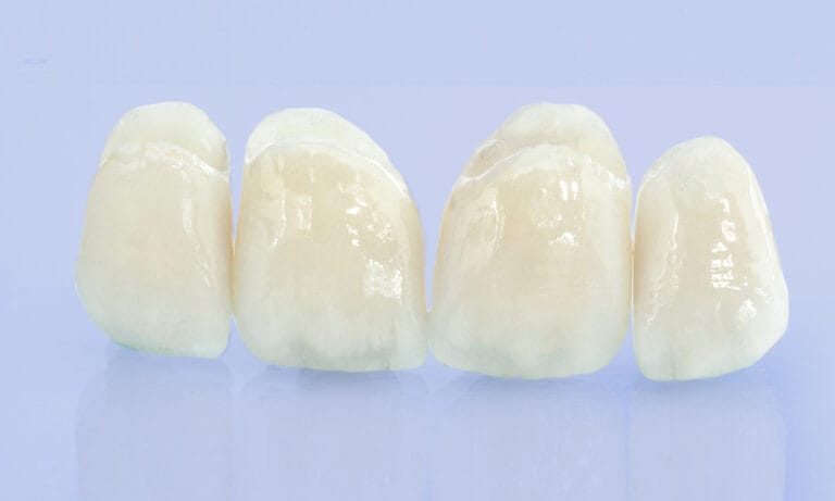 Couronnes dentaires pour adolescents et enfants en Algérie