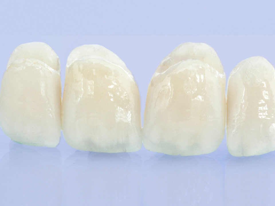 Couronnes dentaires chez l’enfant et l’adolescent : utilité et particularités