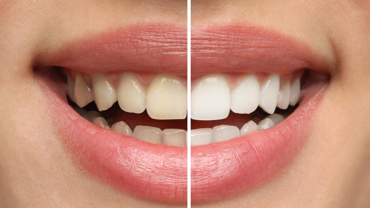 dents jaunes dents blanches causes solutions en Algérie