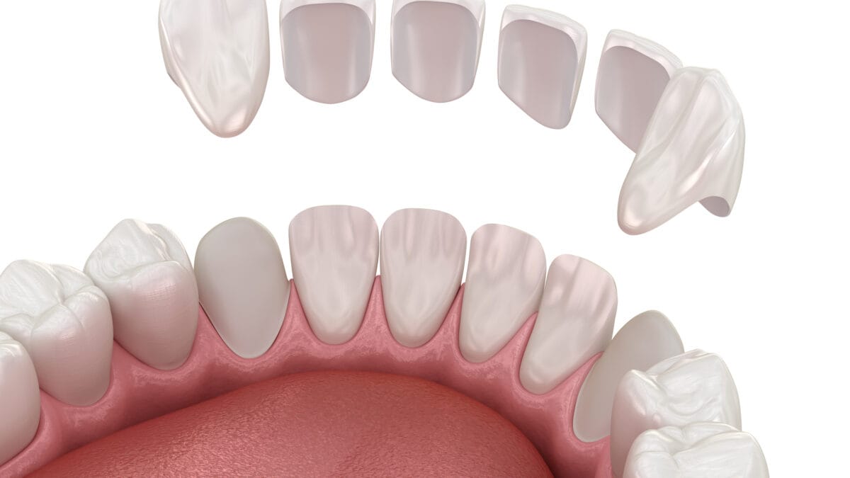 facettes dentaires et couronnes dentaires Algérie