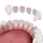 facettes dentaires et couronnes dentaires Algérie