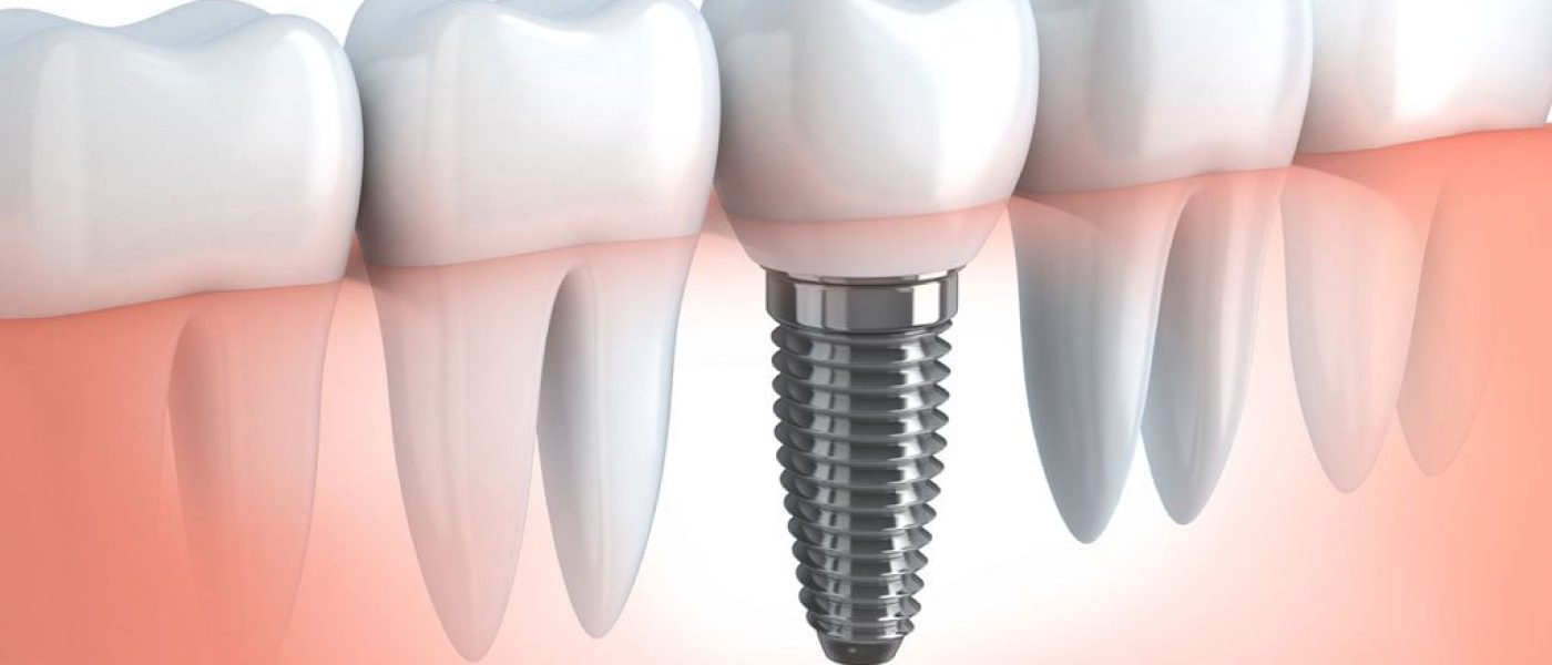 implant dentaire, implantologie, dents manquantes cabinet dentaire blida chirurgien dentiste kara mostefa