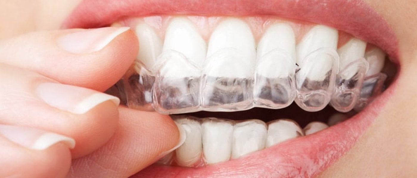 Trouvez vos gouttières dentaires invisibles jusqu'à 60% moins chères