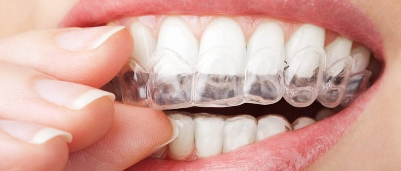 Gouttière dentaire transparente gouttière dentaire invisible appareil dentaire d'alignement des dents a Blida Algerie