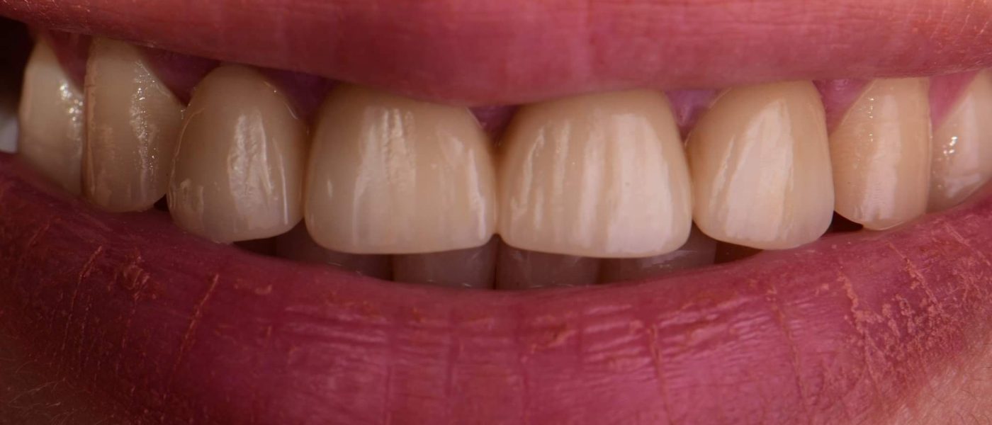 esthétique dentaire facettes dentaires