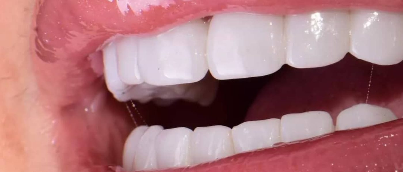 hollywood smile algérie