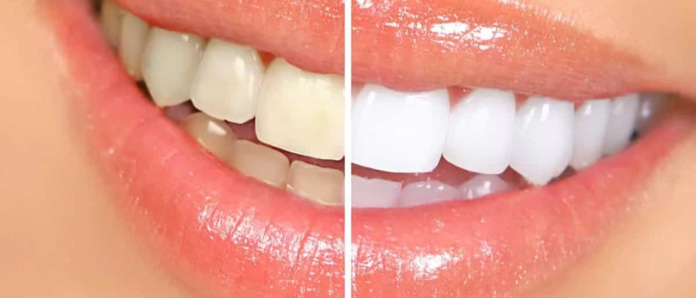 blanchiment des dents, blanchiment dentaire traitement des dents jaunes cabinet dentaire kara mostefa blida algerie