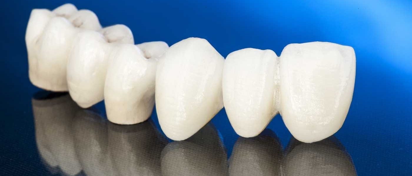 bridge dentaire en Algérie