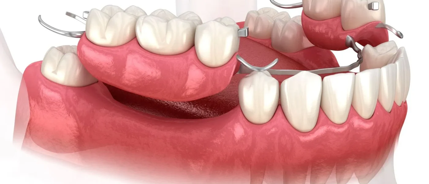 bridge dentaire amovible en Algérie