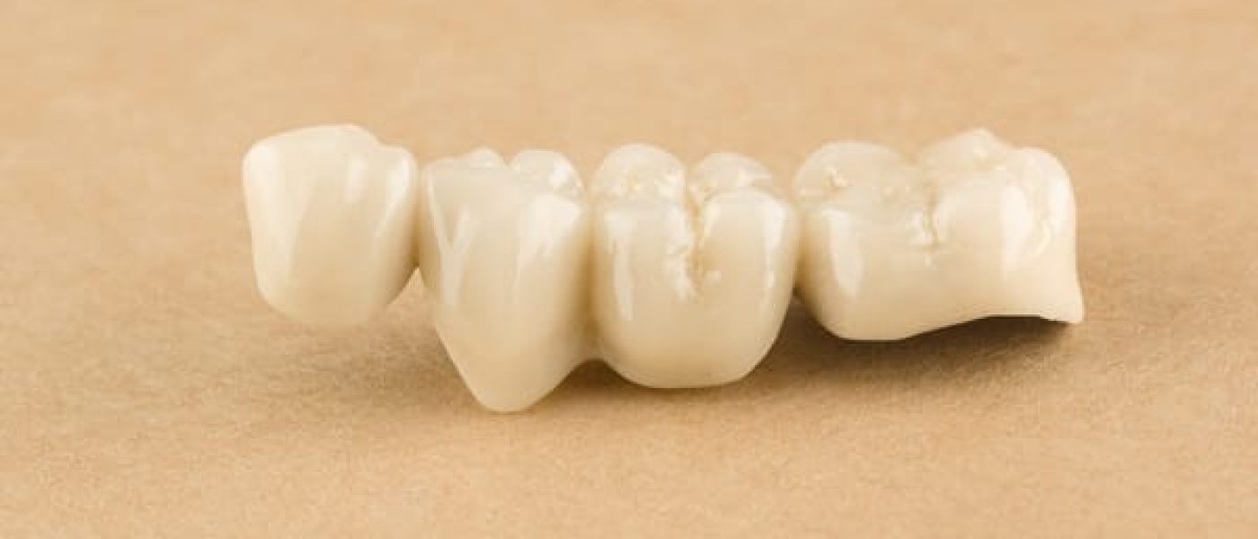 bridge dentaire, durée de vie et alimentation en Algérie