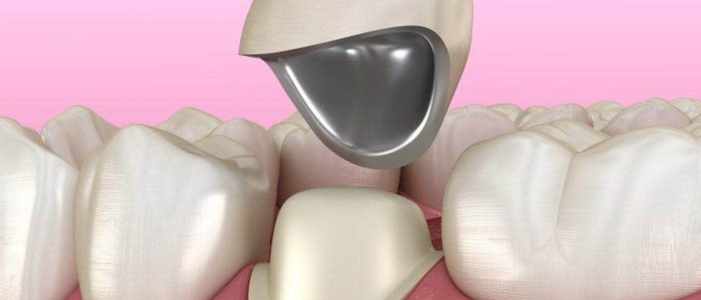 couronne dentaire en Algérie, traitement d'une dent abimée