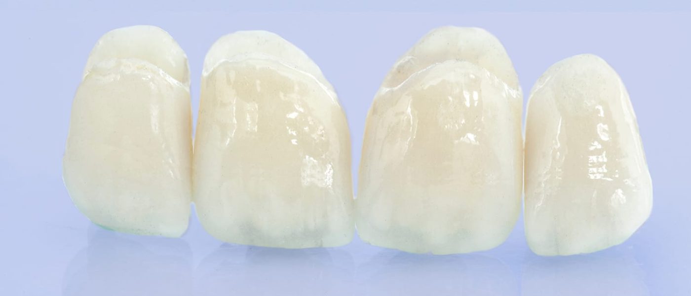 Couronnes dentaires pour adolescents et enfants en Algérie