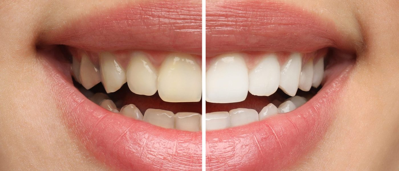 dents jaunes dents blanches causes solutions en Algérie