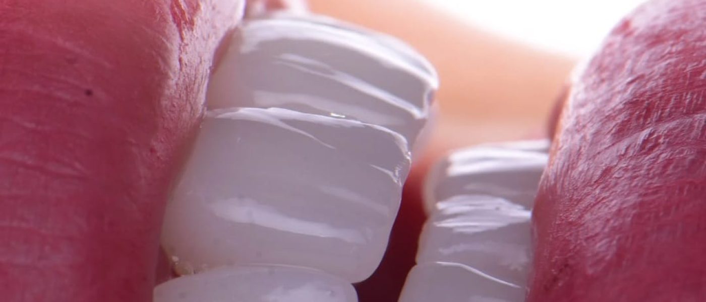 résultat après pose de facettes dentaires en Algérie à Blida, dents parfaitement alignées, hollywood smile