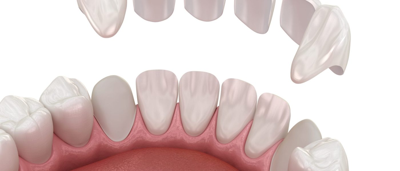 facettes dentaires et couronnes dentaires Algérie