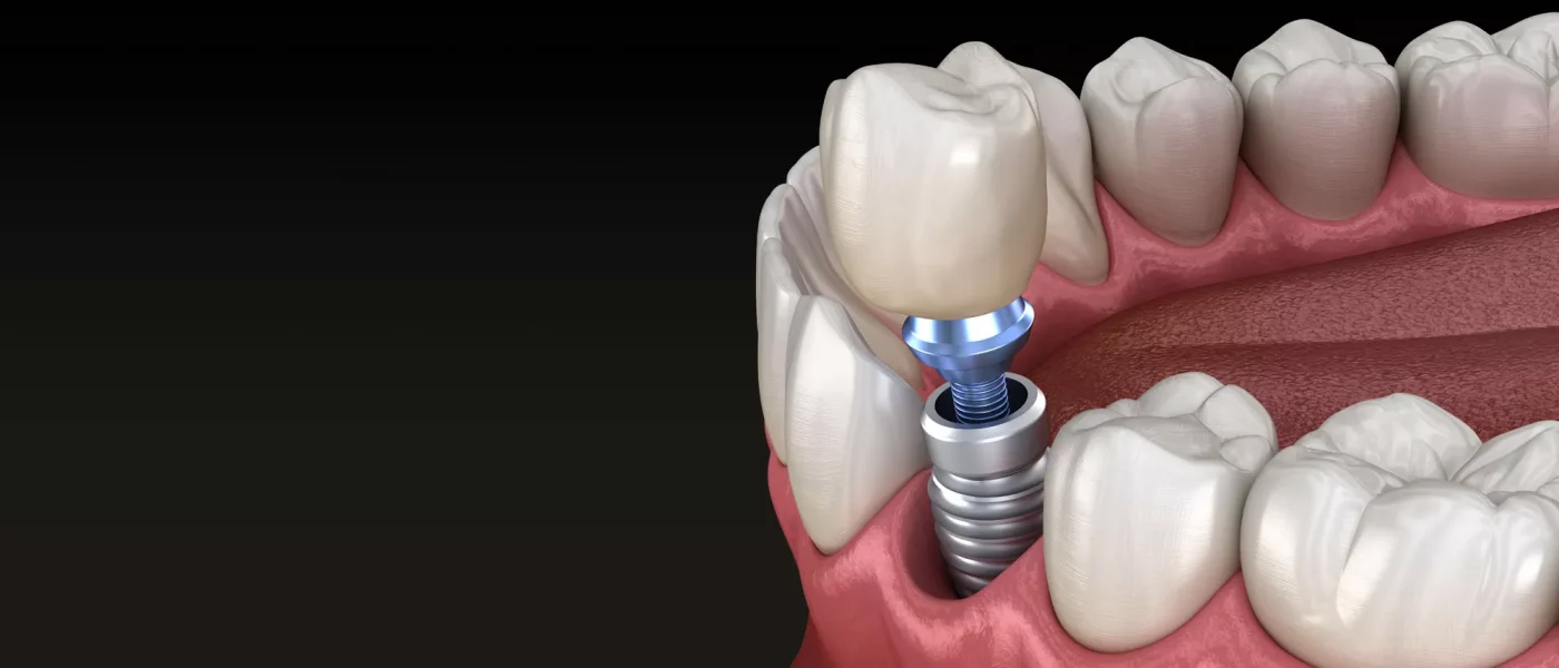 implant dentaire à Blida en Algérie, implant dentaire en zircone à Blida en Algérie